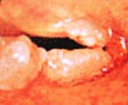 Visão endoscópica da laringe com doença (alteração das pregas vocais).