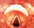 Visão endoscópica normal da laringe.