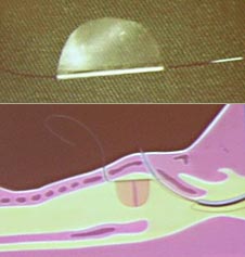Esquema de molde e de como é realizada a colocação desse entre as pregas vocais para o tratamento da estenose / sinéquia da região anterior glótica da laringe (gravura Dr. Cotton).