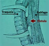 Sequência da uma cirurgia de correção de fístula esofagotraqueal