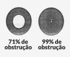 Grau III – De 71% a 99% de obstrução.