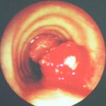 Visão endoscópica de um tumor gerando uma obstrução da luz da traqueia (simula os sintomas que ocorrem em estenoses benignas dessa região).