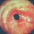 Visão endoscópica da traqueia com estenose circunferencial Grau III.