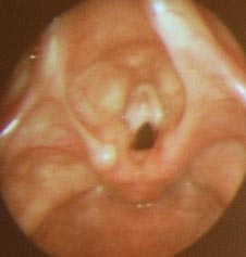 Visão endoscópica de estenose (sinéquia) na região glótica (pregas vocais) da laringe.